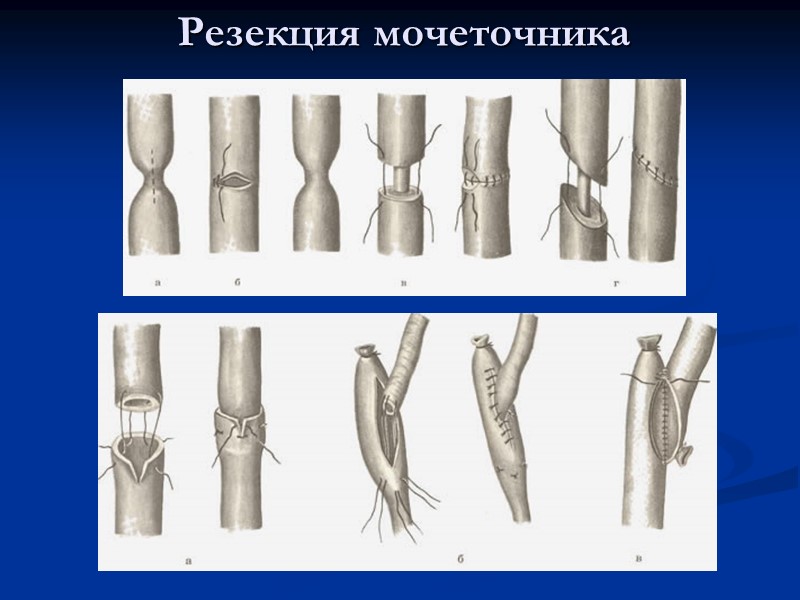 Резекция мочеточника